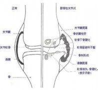 關(guān)節(jié)炎癥狀表現(xiàn)